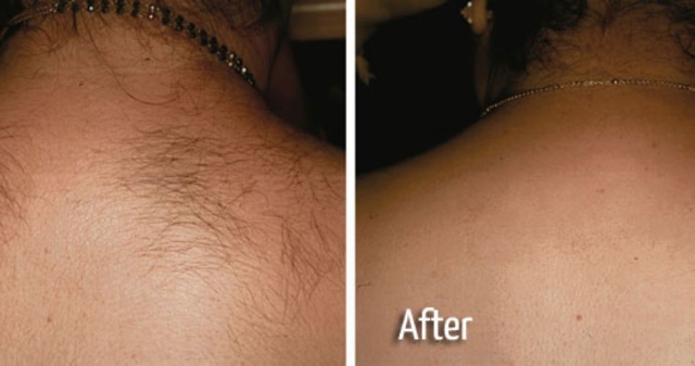 Hair Removal Back