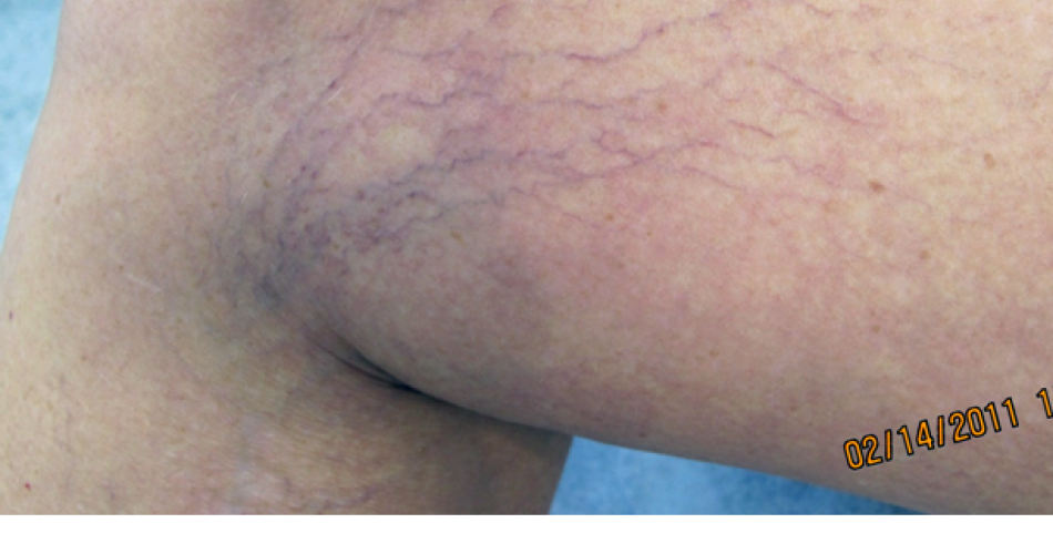 Sclerotherapy Before